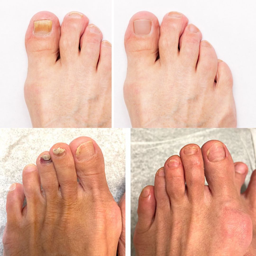 DermaNail - patentierte Nagelpilz-Therapie - für gesunde Nägel innerhalb von 3 Wochen