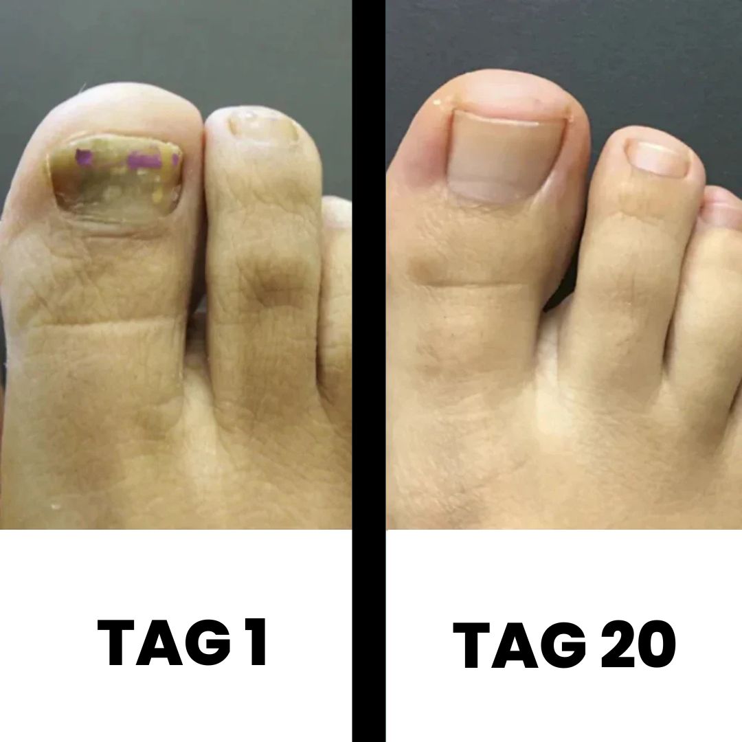 DermaNail - patentierte Nagelpilz-Therapie - für gesunde Nägel innerhalb von 3 Wochen