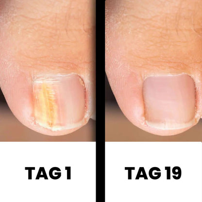 DermaNail - patentierte Nagelpilz-Therapie - für gesunde Nägel innerhalb von 3 Wochen