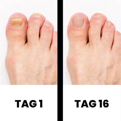DermaNail - patentierte Nagelpilz-Therapie - für gesunde Nägel innerhalb von 3 Wochen