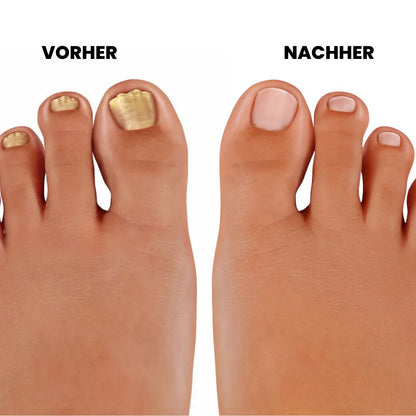 DermaNail - patentierte Nagelpilz-Therapie - für gesunde Nägel innerhalb von 3 Wochen